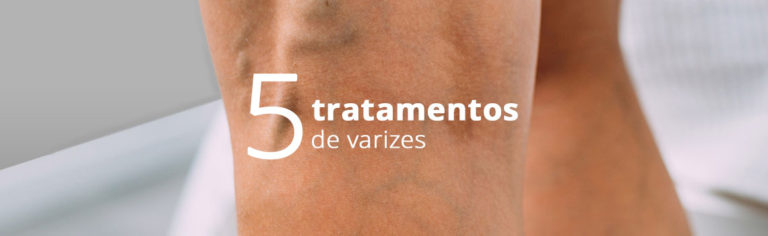 5 Tratamentos De Varizes Rovaris Med